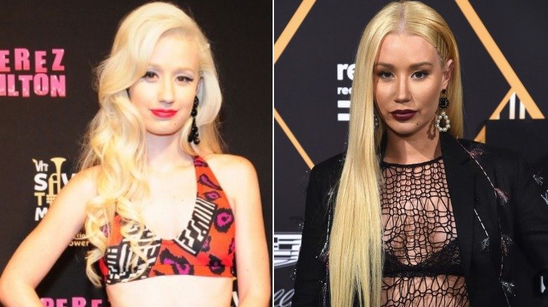 Iggy Azalea antes y después de la cirugía plástica