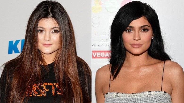 Kylie Jenner antes y después de los rellenos labiales