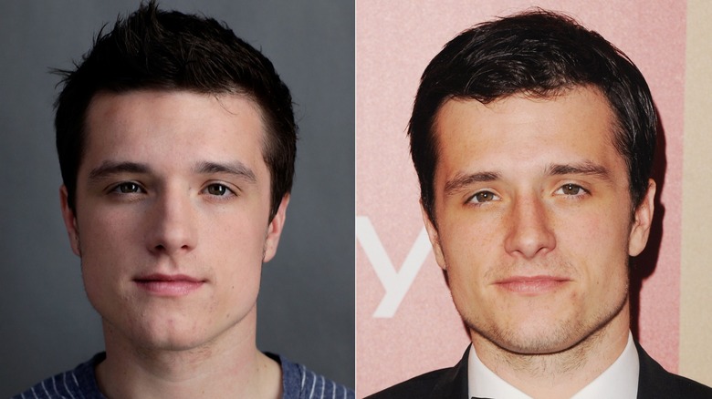 Josh Hutcherson antes y después de la cirugía